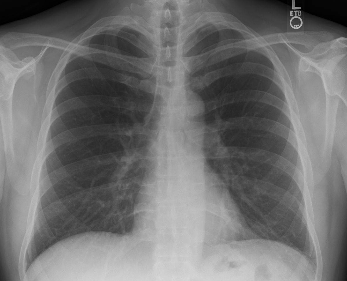 흉부 X-ray 원본 이미지 — 전자건강기록에는 '폐 하부에 음영' 한 줄로만 기록되는 시각 정보