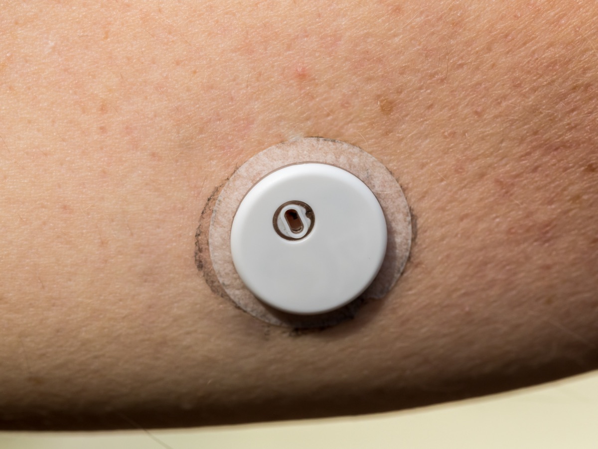 팔에 부착된 연속혈당측정(CGM) 센서 — 이 논문의 원자료를 만든 것과 같은 종류의 기기