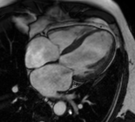 4-챔버 장축 뷰 심장 MRI CINE 영상 예시 — 좌우 심방·심실이 보이는 단면