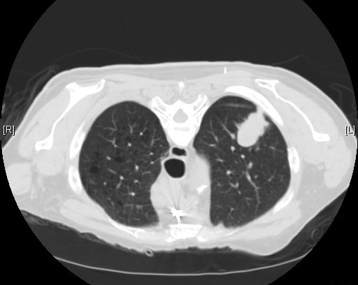 비소세포폐암 선암을 보여주는 흉부 CT 단면 영상