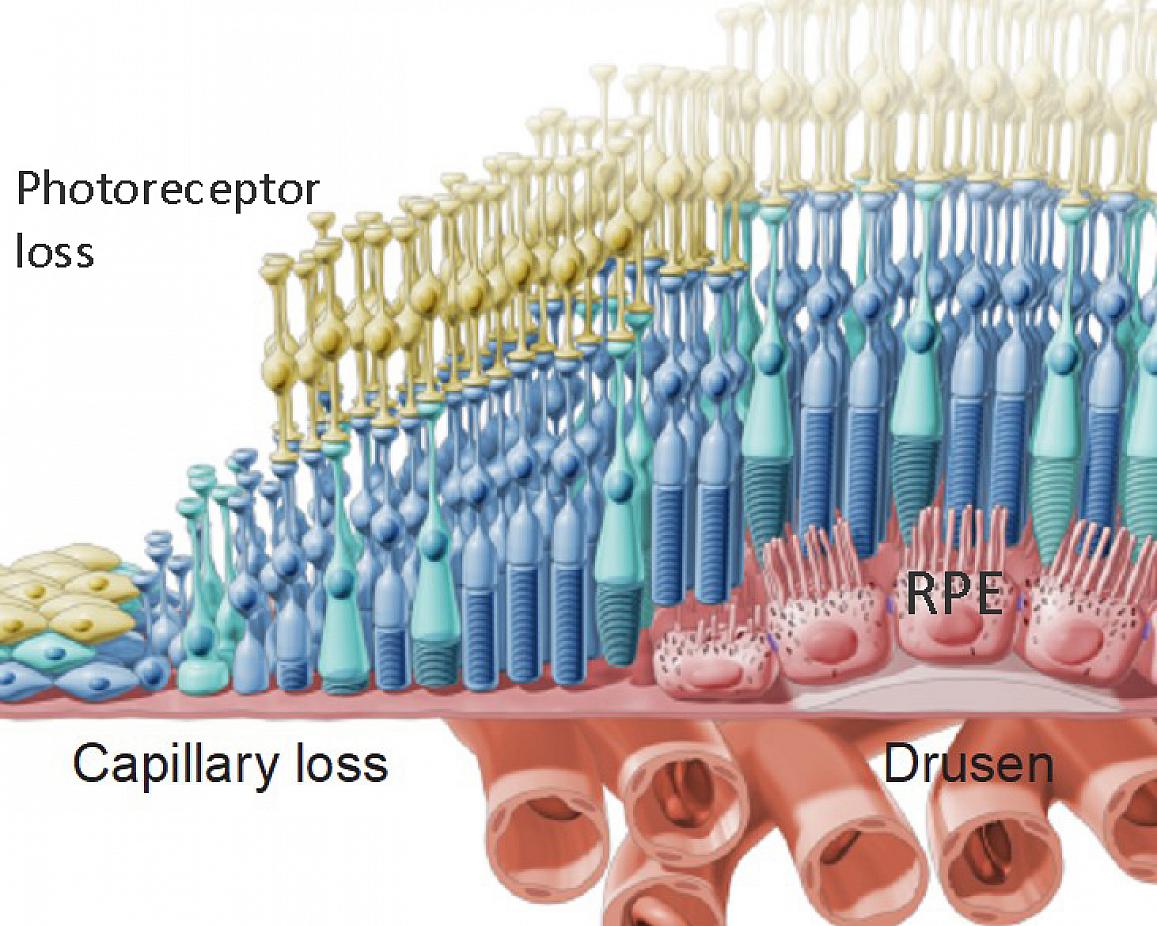 Dry AMD retinal structure illustration showing photoreceptor loss, RPE cells, drusen deposits, and capillary loss — the pathology Robin was targeting